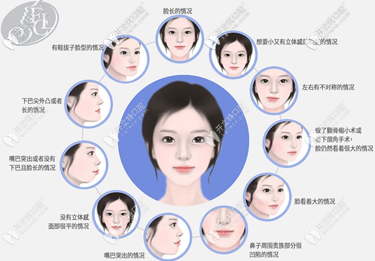 哪些情況適合做smart雙顎手術(shù)