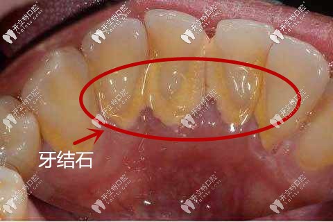 牙結(jié)石圖片