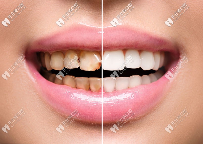 牙齒冷光美白前后對(duì)比照