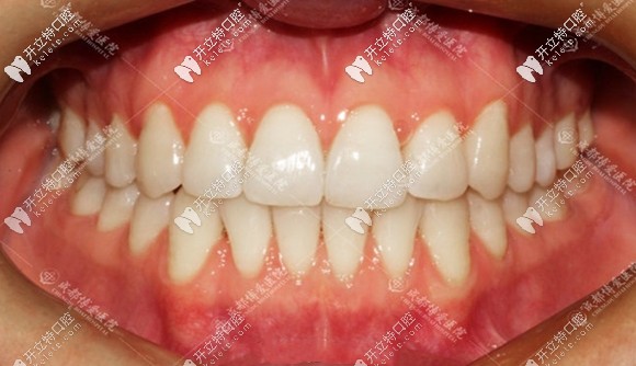 牙齒開頜矯正后效果圖 牙齒開頜矯正后效果圖