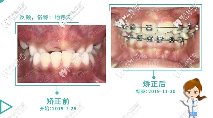 記錄8歲兒童牙性地包天戴mrc矯正器+國產金屬自鎖牙套的經歷