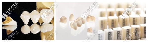 牙齒缺損了做烤瓷牙還是瓷?？贪?做過的說說哪個好