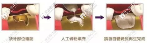 種植牙骨粉填充過程