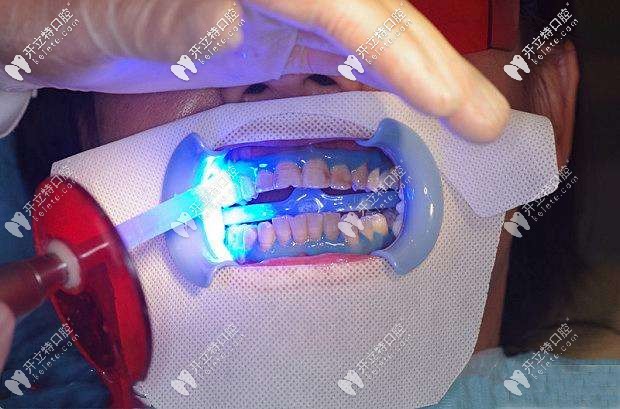 冷光美白操作方法