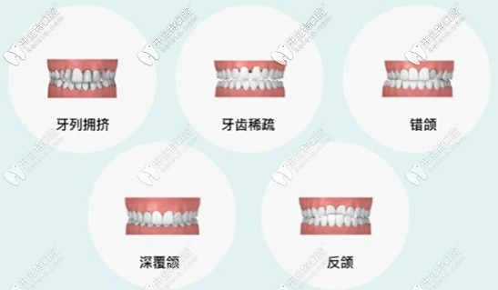 六大情況適合隱適美矯正