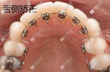 舌側(cè)矯正圖片