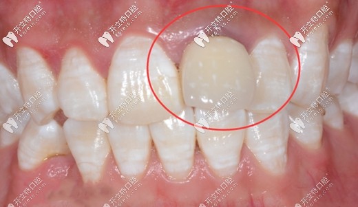將過渡義齒用螺絲固位能方便檢查種植體的穩(wěn)定性