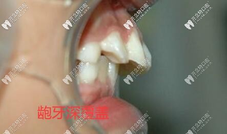 要不是骨性齙牙我不會選擇比隱形牙套貴的舌側(cè)矯正