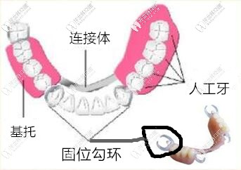 隱形義齒雖然也是活動義齒但是區(qū)別還是有點(diǎn)大