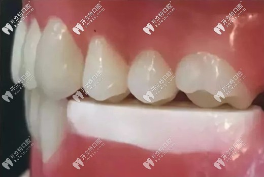 戴臨時義齒還可防止植體周圍菌斑附著