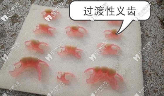 誰知道種植牙的過渡義齒能用多久呢?若長期佩戴可以嗎？