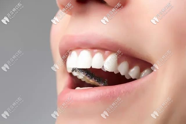 舌側(cè)隱形牙套進(jìn)口和國產(chǎn)的矯正效果有區(qū)別嗎?價格竟差2萬多