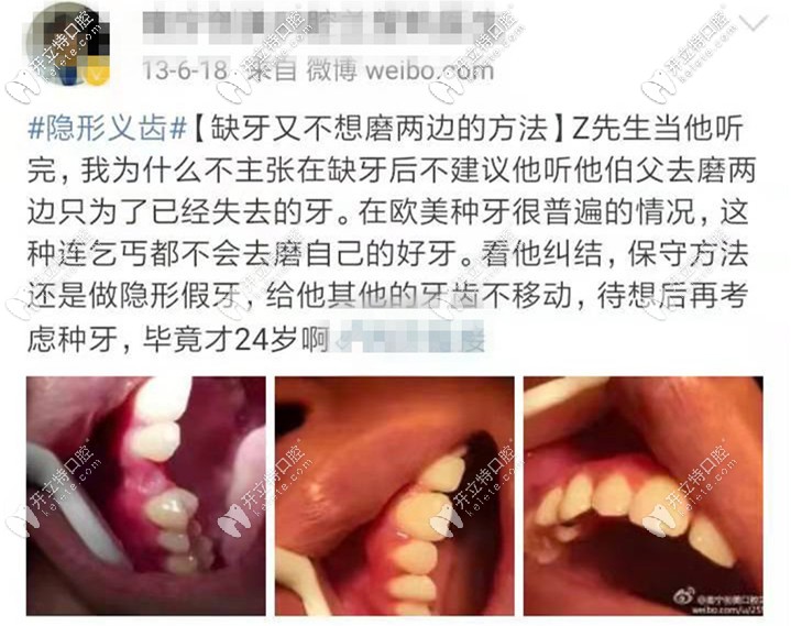 年紀(jì)輕輕缺牙醫(yī)生建議做隱形義齒