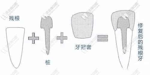 爛牙根修復后圖示 爛牙根修復后圖示