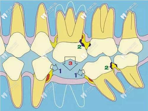爛牙根不拔后果 爛牙根不拔后果