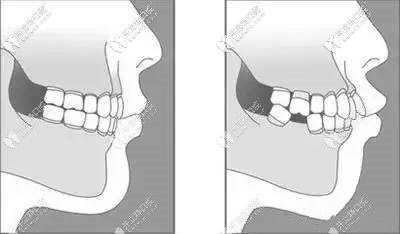 爛牙根拔除后圖片 爛牙根拔除后圖片