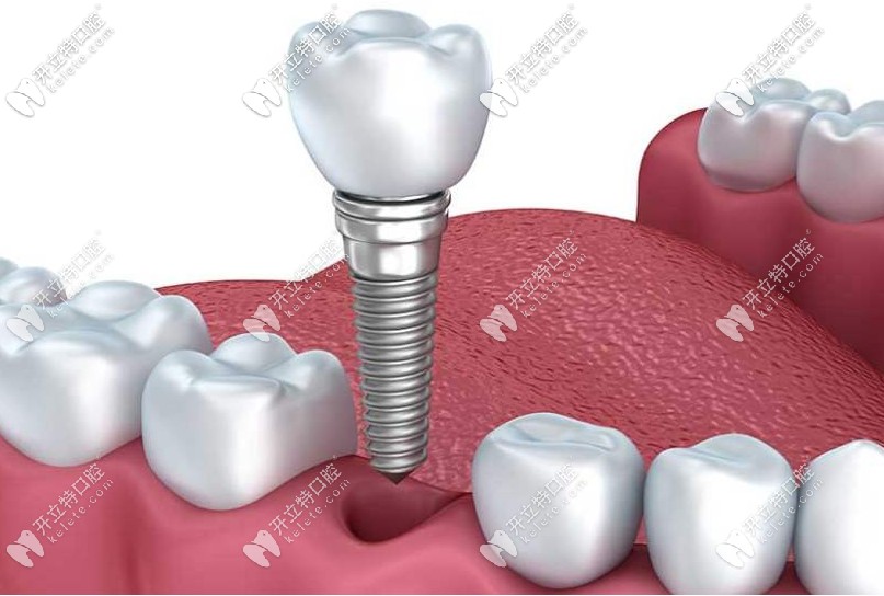 種植牙活動(dòng)