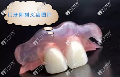 門(mén)牙即刻義齒圖片