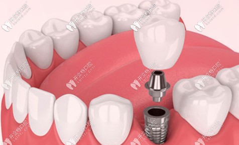 皓圣種植牙活動(dòng)內(nèi)容