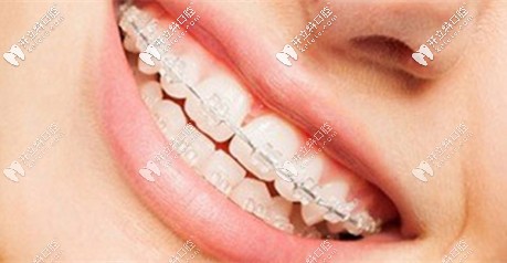 陶瓷半隱形牙套活動