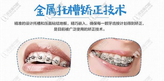 金屬托槽矯正技術