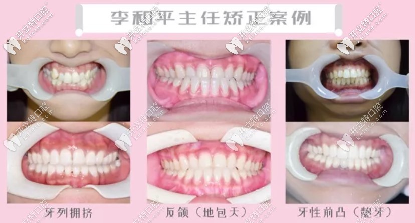 李醫(yī)生部分正畸案例圖