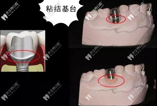 粘結(jié)基臺的臨床應(yīng)用