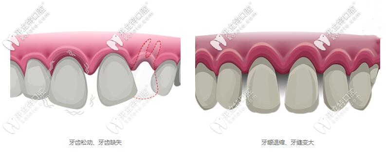 牙周炎是什么癥狀