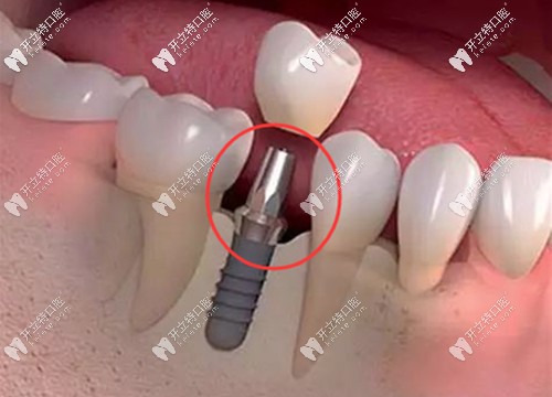 基臺是種植牙系統(tǒng)中非常重要的一個(gè)部件