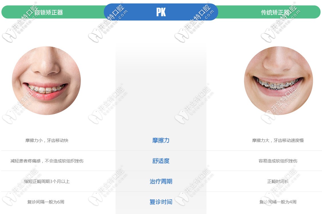 自鎖托槽矯正和傳統(tǒng)矯正區(qū)別