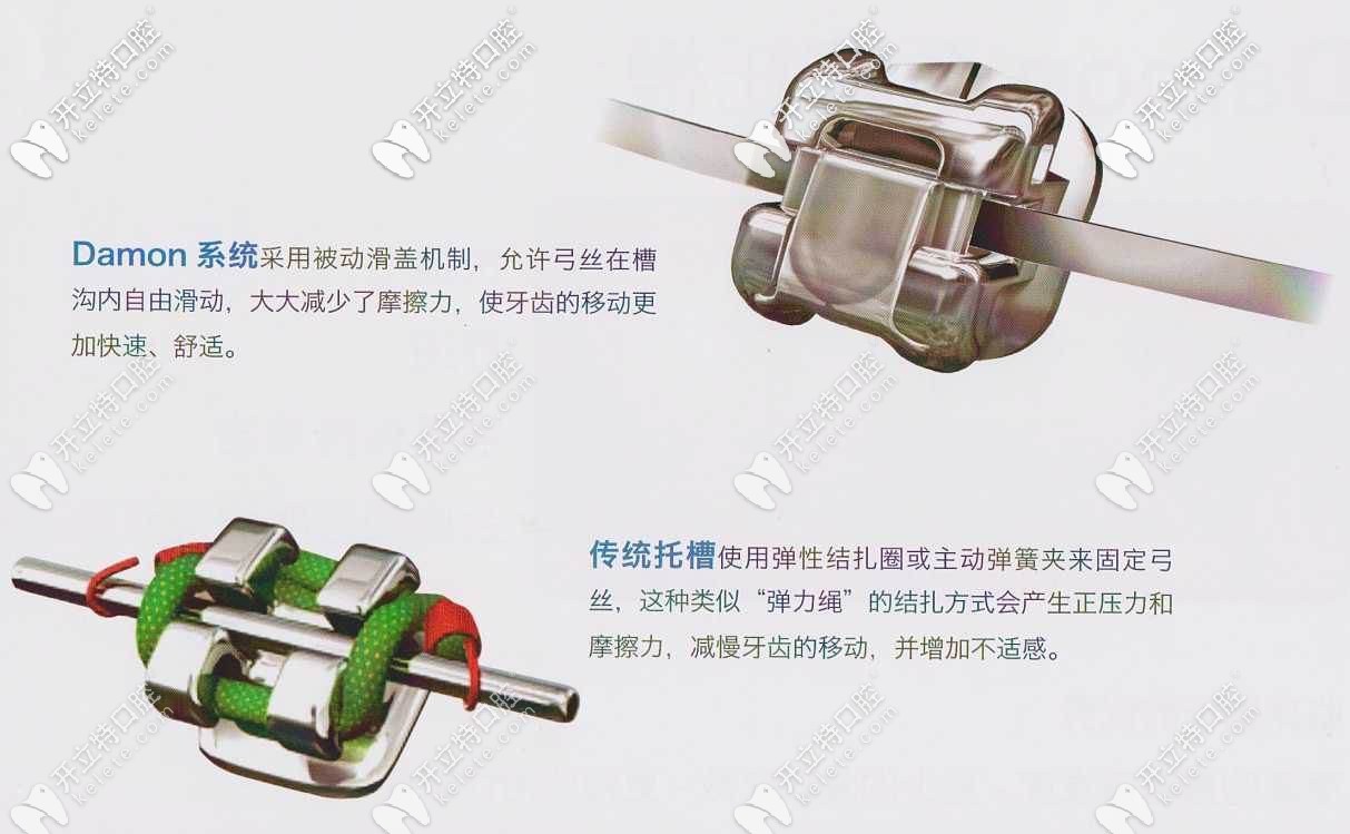 自鎖托槽矯正和傳統(tǒng)矯正區(qū)別