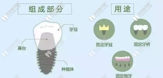 種植體的三個步驟及用途