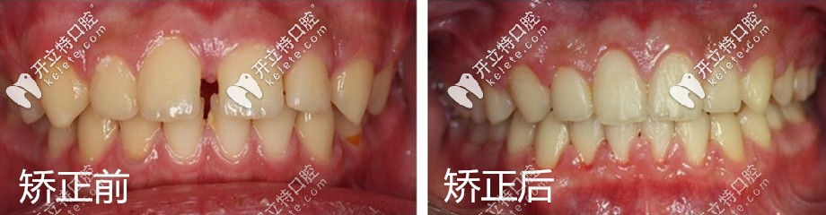 做牙齒矯正的前后對(duì)比圖