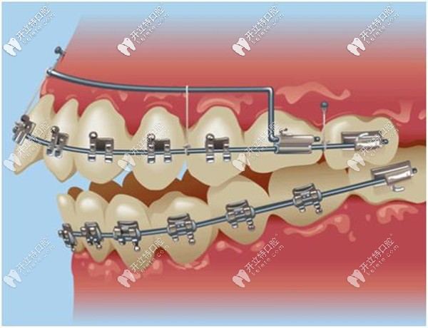 金屬自鎖托槽牙齒矯正優(yōu)惠價(jià)格