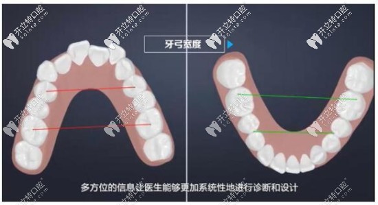 數(shù)字化牙齒矯正優(yōu)惠價(jià)格