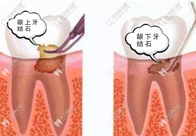 洗牙竟然還要把牙齦翻開(kāi)洗?這是神馬操作!