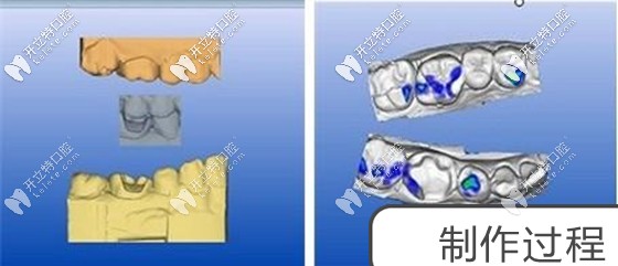 修復完成后牙齒咀嚼效率會比較高