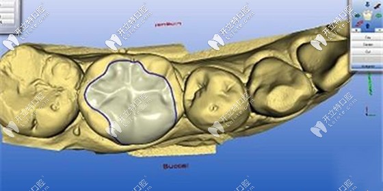 玻璃陶瓷嵌體的缺點是對于真牙缺損大的牙不適合