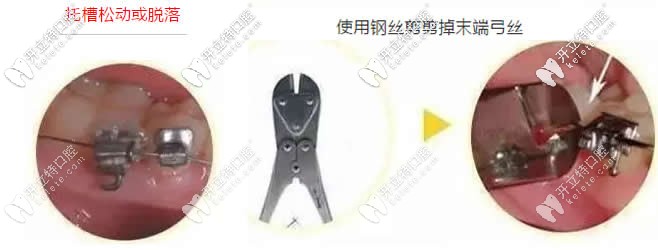 牙齒矯正中托槽松動(dòng)脫落怎么辦