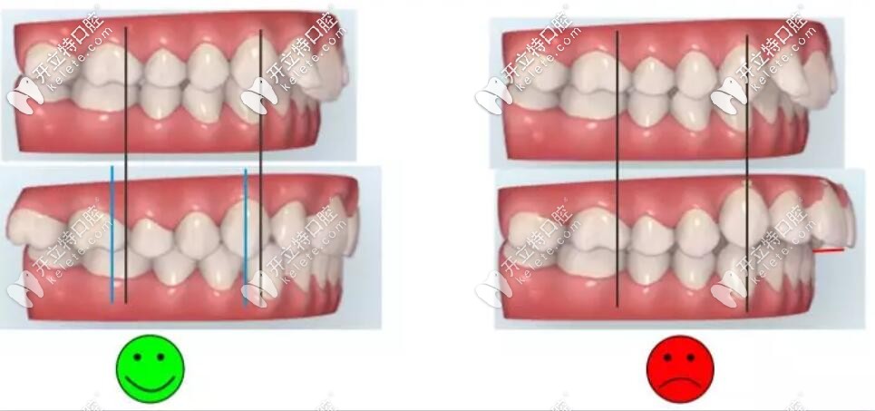 隱適美磨牙后推的界限