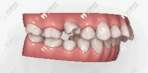 隱適美推磨牙過程