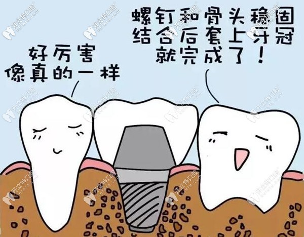 微創(chuàng)種植牙效果