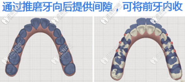 通過推磨牙向后提供間隙來將前牙內(nèi)收