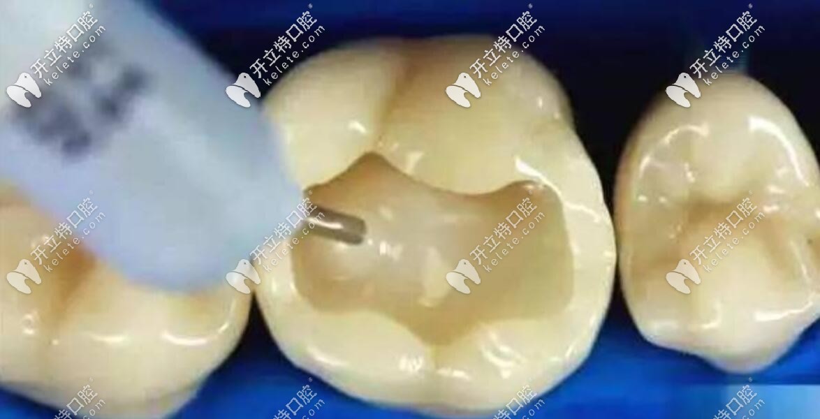 樹脂嵌體和瓷嵌體價(jià)格相差那么大，到底有啥區(qū)別？