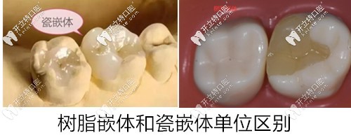樹脂嵌體和瓷嵌體的區(qū)別