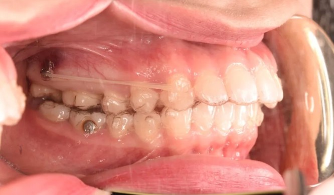 妹紙做隱適美磨牙后推打骨釘?shù)恼澜?jīng)歷,沒想到效果挺不錯