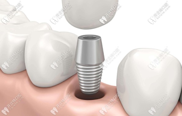 臨時(shí)牙冠不慎脫落該怎么辦