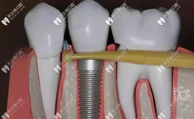 種植牙崩瓷怎么辦