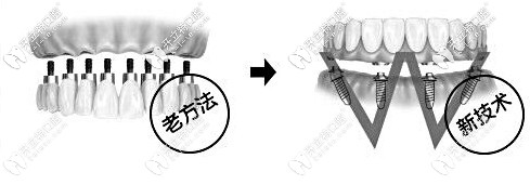 北京立得用種植牙技術(shù)