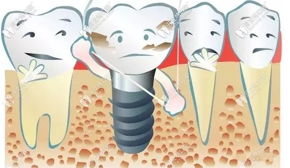 種植牙瑞士和韓國(guó)哪個(gè)好